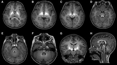 Case Report: A rare form of congenital erythrocytosis due to SLC30A10 biallelic variants—differential diagnosis and recommendation for biochemical and genetic screening